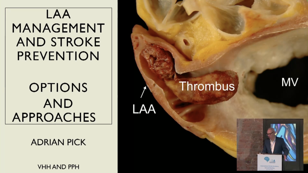 Left Atrial Appendage Management | Adrian Pick
